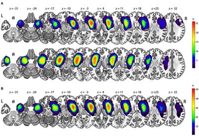 Contralesional Structural Plasticity in Different Molecular Pathologic Subtypes of Insular Glioma